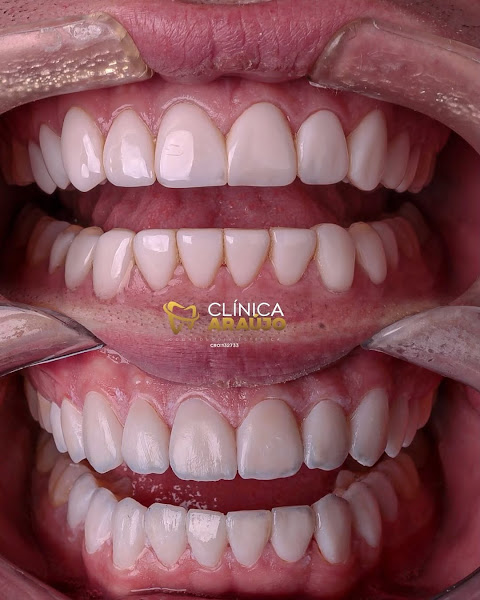 Foto 3 de Clinica Dr Felipe Araujo - Faceta de Resina em Barra da Tijuca - Lente de Contato Dental - Lentes de Porcelana