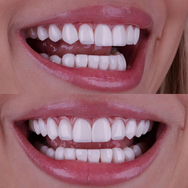 Foto 2 de Clinica Dr Felipe Araujo - Facetas de Resina em Itaquaquecetuba - Lente de Contato Dental - Lente de Porcelana