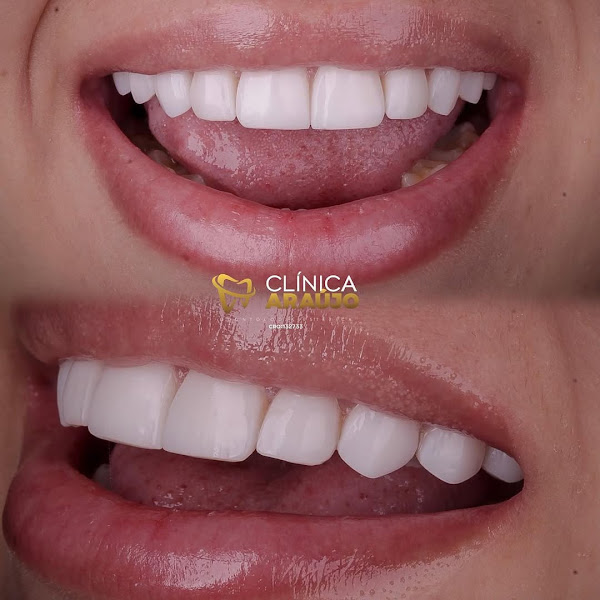 Foto 3 de Clinica Dr Felipe Araujo - Facetas de Resina em Itaquaquecetuba - Lente de Contato Dental - Lente de Porcelana