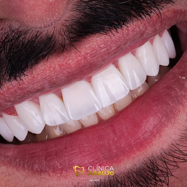 Foto 2 de Clínica Dr Felipe Araujo Praia Grande - Lentes de contato dental - Dente de Resina - Lente Porcelana em Praia Grande