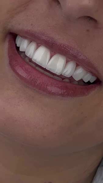 Foto 3 de Clínica Dr Felipe Araujo Praia Grande - Lentes de contato dental - Dente de Resina - Lente Porcelana em Praia Grande