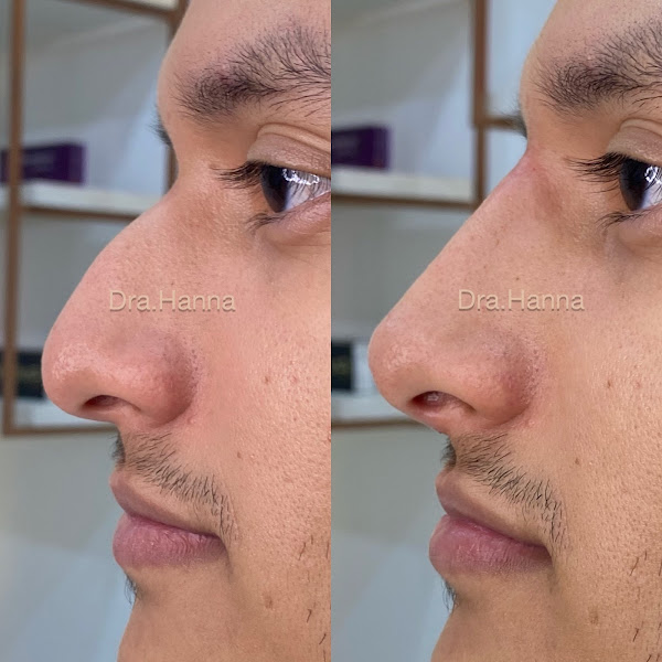 Foto 3 de Clínica Dra. Hanna Ariela • Harmonização Facial