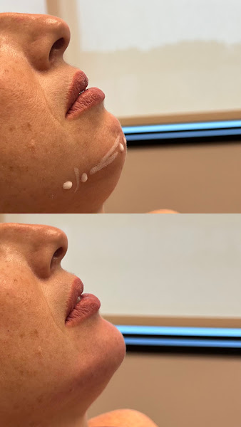 Foto 2 de Clínica Dra. Pietra Roschel - Harmonização Orofacial