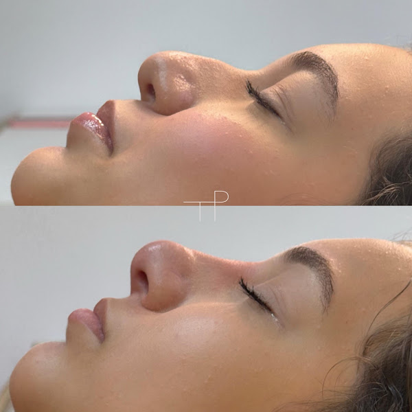 Foto 3 de Clínica Dra. Thalita Porcino • Harmonização Facial