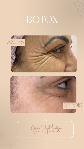 Foto 3 de Clínica Estética DM Harmonize | Harmonização Facial | Botox | Preenchimento Labial | Harmonização Corporal