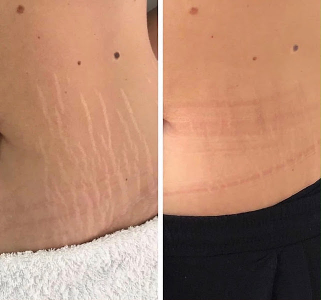 Foto 2 de Clínica Estética Dra. Aline Moreti em São Caetano do Sul - SP, Microagulhamento, Jato de Plasma, Peeling, Botox, Fios de PDO