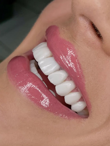 Foto 2 de Clínica Farinelli - Lentes em resina | Tucuruvi - SP