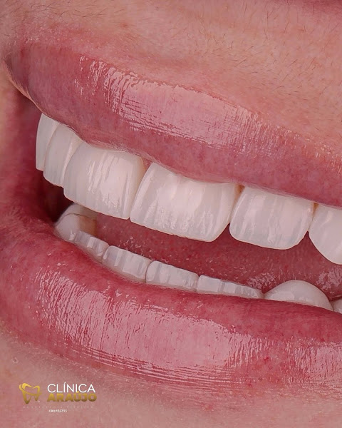 Foto 2 de Clinica Felipe Araújo BH - Facetas de Resina em Belo Horizonte - Lentes de Contato Dental - Lentes de Porcelana