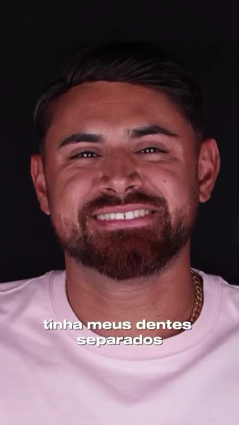 Foto 3 de Clinica Felipe Araújo BH - Facetas de Resina em Belo Horizonte - Lentes de Contato Dental - Lentes de Porcelana