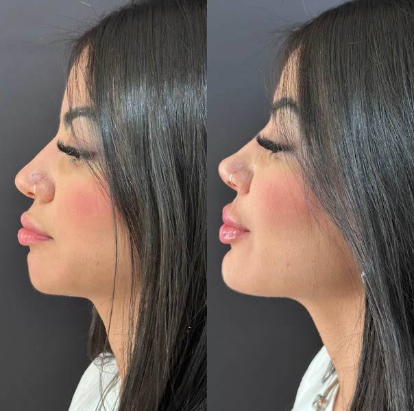 Foto 3 de Clínica Freitas: Dra Isabelly Freitas. Harmonização Facial Três Lagoas MS