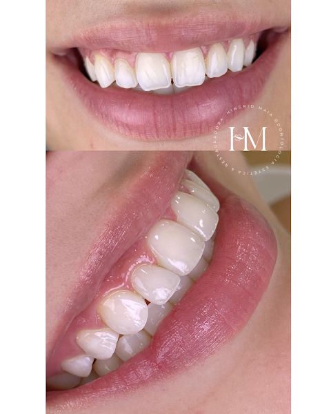 Foto 2 de Clínica Hingrid Maia | Facetas em resina | Botox em Niterói