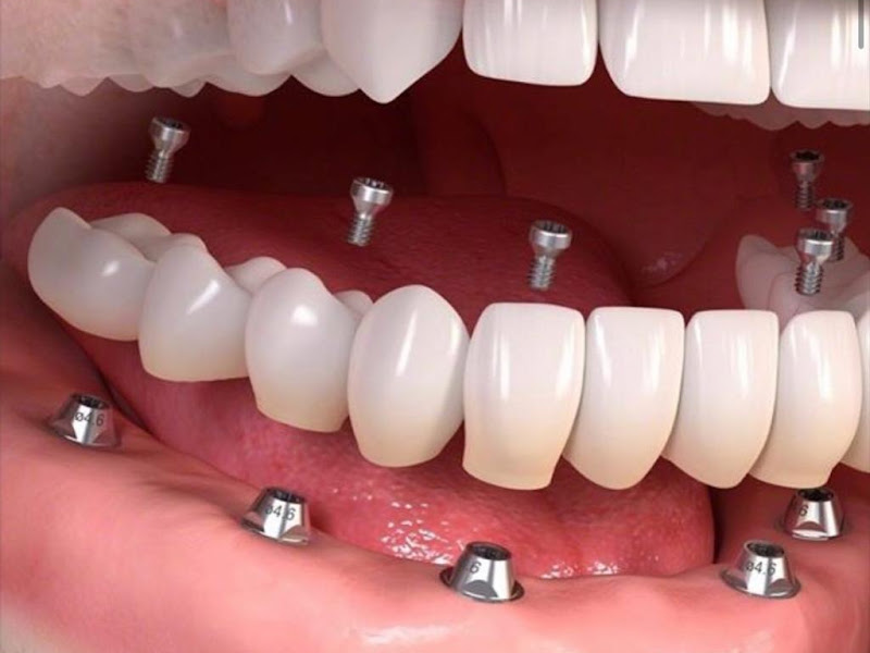 Foto de Clínica Implante Dentes