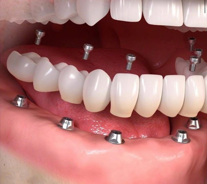 Foto 2 de Clínica Implante Dentes