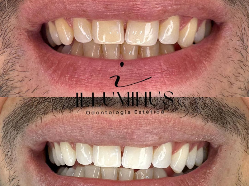 Foto 8 de Clínica Luminus Odonto - Dentista e Reabilitação Oral Implante Prótese Fixa Ponte Lagoa Nova Rn