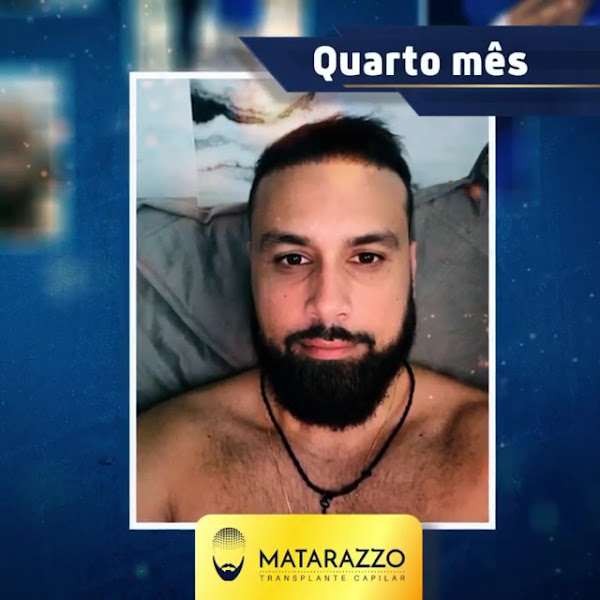 Foto 3 de Clínica Matarazzo Transplante Capilar RJ
