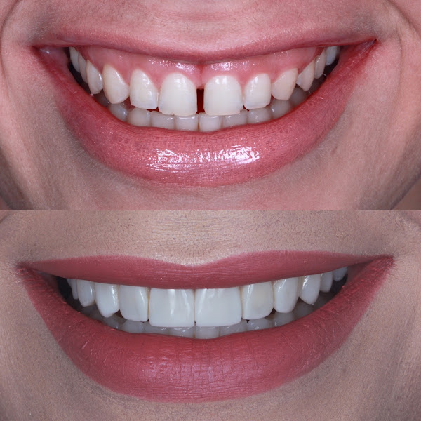 Foto 3 de Clínica Nouva - Implantes dentários - Lente de Contato - Urgência Odontológica - Faceta de Resina - Tratamento de Canal