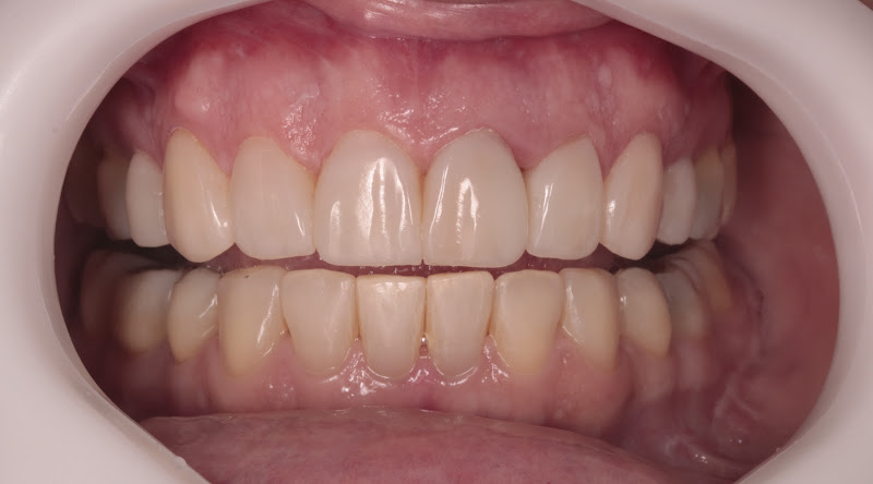 Foto 3 de Clinica Odontológica na Asa Norte Brasília, Dra Kelma - Tratamento Para DTM e Bruxismo, Faceta de Porcelana, Resina, Implante