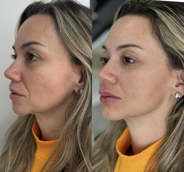 Foto 3 de Clínica Renata Ávila - Harmonização Facial