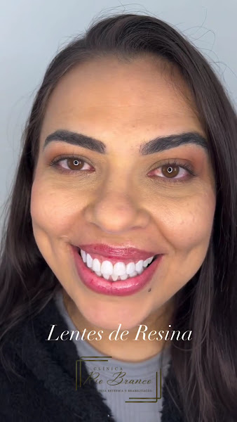 Foto 4 de Clínica Rio Branco | Dra Thais | Lentes de resina | Implantes dentários