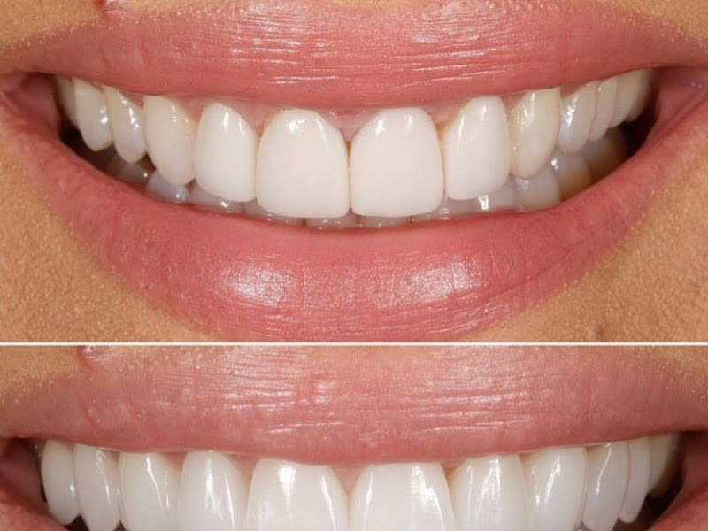 Foto 7 de Clínica Rio Branco | Dra Thais | Lentes de resina | Implantes dentários