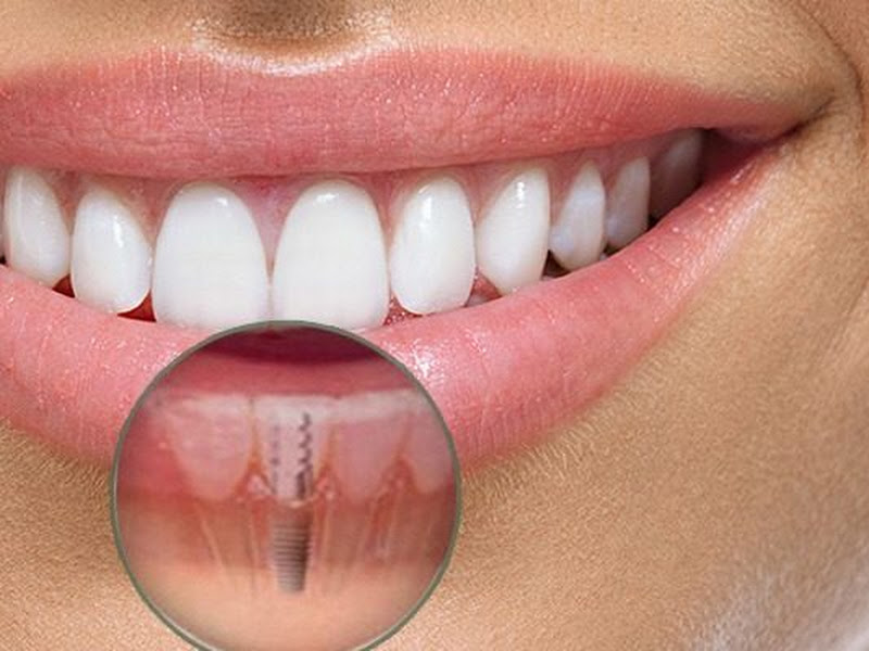 Foto 8 de Clínica Rio Branco | Dra Thais | Lentes de resina | Implantes dentários