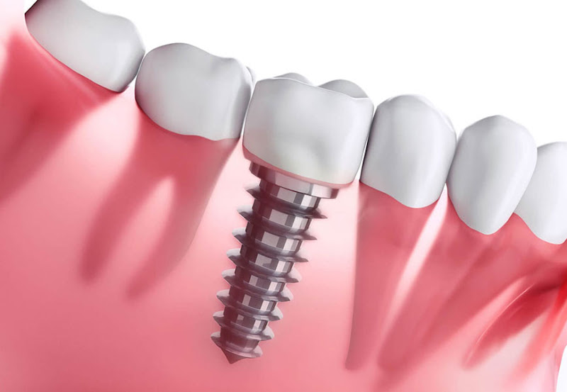 Foto 3 de Clinica Vita: Implante dentário, Clareamento Dental, Dentista, Fortaleza CE