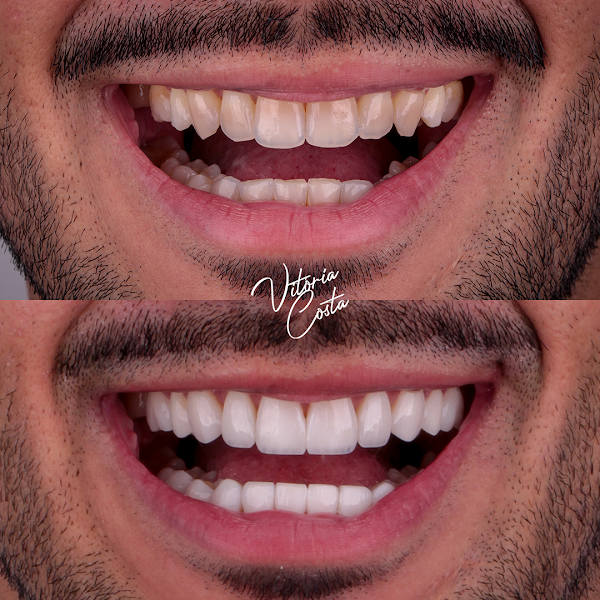 Foto 3 de Clínica Vitoria Costa | Lentes em Resina e Porcelana