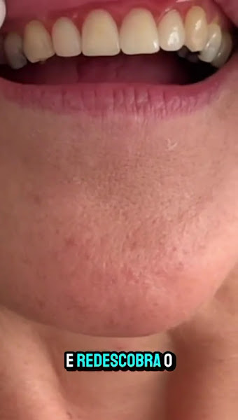 Foto 3 de Clinika odontologia dra Flávia Mendes/CLAREAMENTO /ESTÉTICA DENTAL/ FACETAS/PRÓTESES