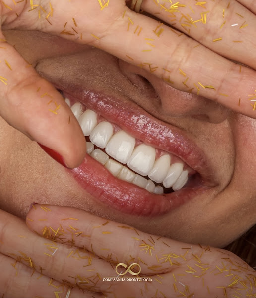 Foto 3 de Comesanha Odontologia - Implantes, Lentes de contato dental, Reabilitação Oral