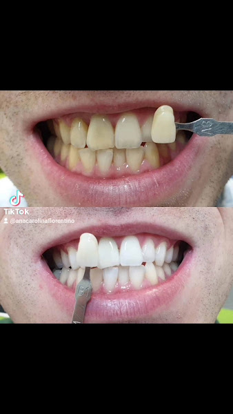 Foto 3 de Consultório Dentista Dra Ana Carolina | Clareamento dental