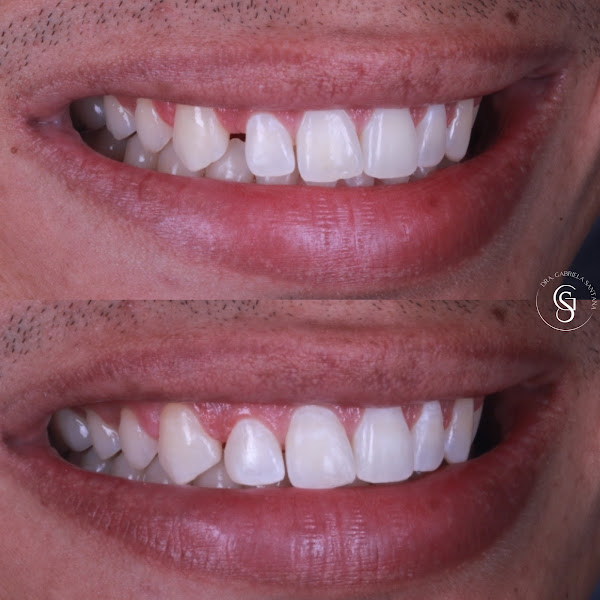 Foto 2 de Consultório Dra Gabriela Santana / Facetas em resina