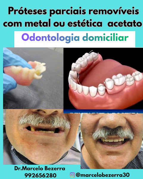 Foto 3 de Consultório Odontológico Dr. Marcelo de Souza Bezerra implantes ,odontologia domiciliar aparelhos ortodonticos