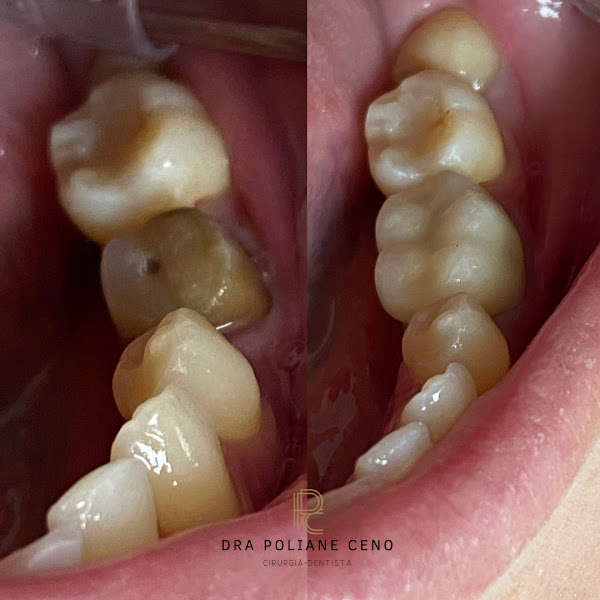 Foto 3 de Consultório odontológico Dra Poliane Ceno - Aparelho Dental Adultos e Crianças