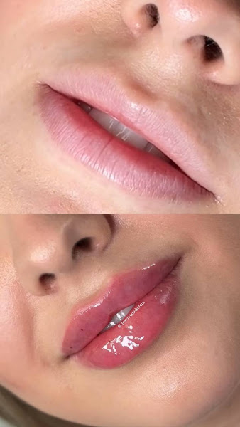 Foto 2 de Consultório Odontológico Dra. Viviane Kelma- Lipo de Papada Recife | Harmonização Facial Camaragibe