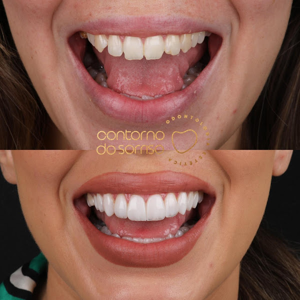 Foto 4 de Contorno do Sorriso
