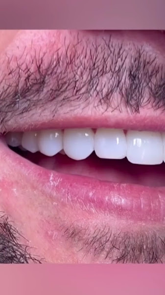 Foto 3 de Coralli Odontologia e Saúde | Ponta Grossa | Implantes dentários | Alinhadores invisíveis | Facetas