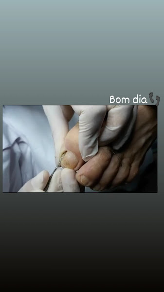 Foto 2 de Cris Linhares Podóloga - Podologia em Valparaíso de Goiás | Unha encravada | Micose nas unhas