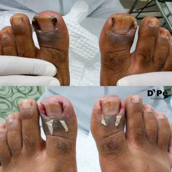 Foto 2 de D'Pé Podologia