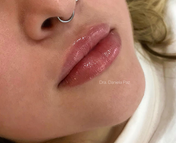 Foto 2 de Daniela Paz - Harmonização Facial em Fortaleza