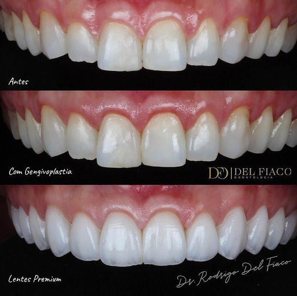 Foto 2 de Del Fiaco Odontologia | Lentes em Porcelana