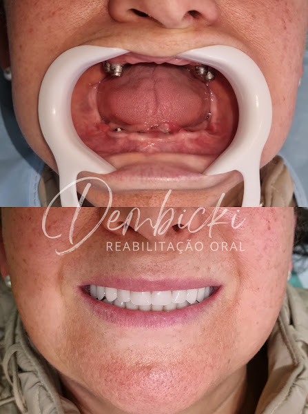 Foto 3 de Dembicki | Reabilitação oral