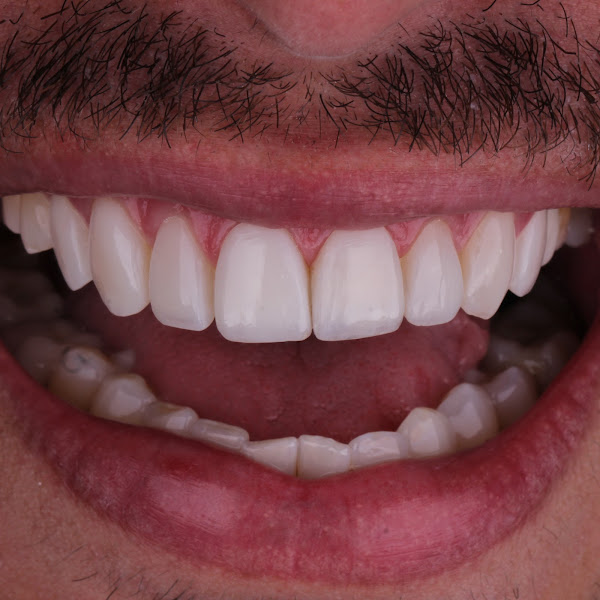 Foto 3 de Dental Clean – Implantes Dentários, Facetas em Resina e Lentes de Contato Dental