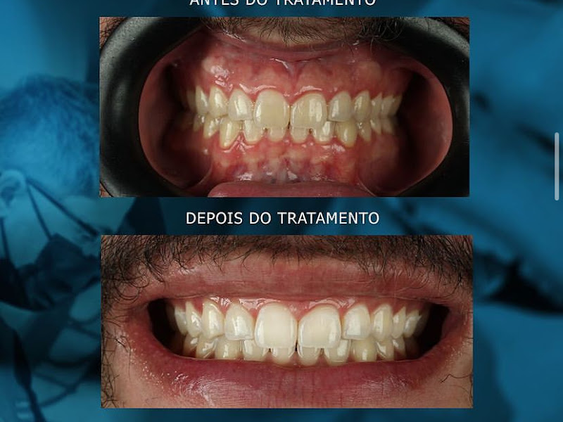 Foto 7 de Dental Clean – Implantes Dentários, Facetas em Resina e Lentes de Contato Dental