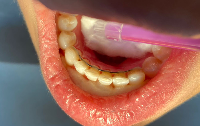 Foto 3 de DENTISTA 24 HORAS JARAGUÁ DO SUL EMERGÊNCIA PRECISA AGENDAR, ATENDIMENTO SOMENTE PARTICULAR!