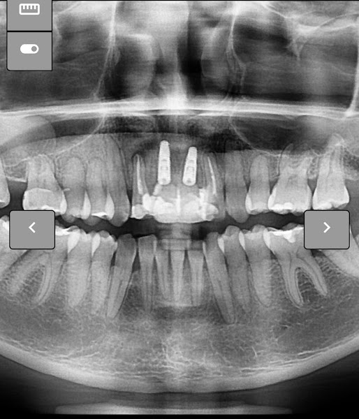 Foto 3 de DENTISTA AVENIDA PAULISTA / DOR DE DENTE - DR JUVÊNCIO NETO / ENDODONTIA / INVISALIGN.