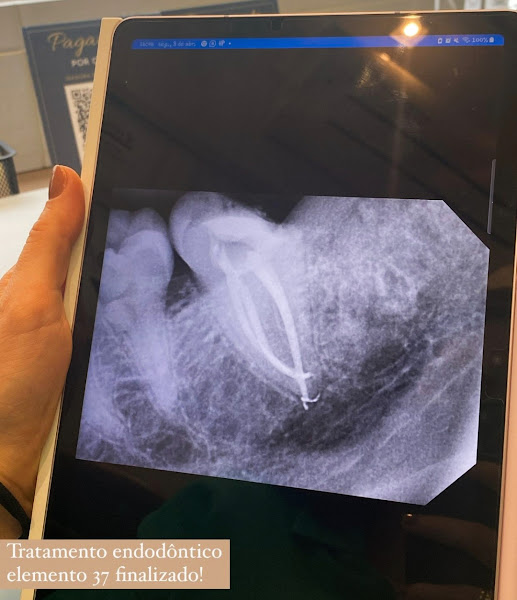Foto 3 de Dentista Criciúma | Isadora de Bem | Endodontia