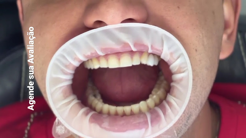 Foto 5 de 🤵DENTISTA DE URGENCIA 24HS - Dentista em Moema (BUCOMAXILOFACIAL) Implantes - Protocolo - Cirurgia Ortognática - ATM - Sisos.