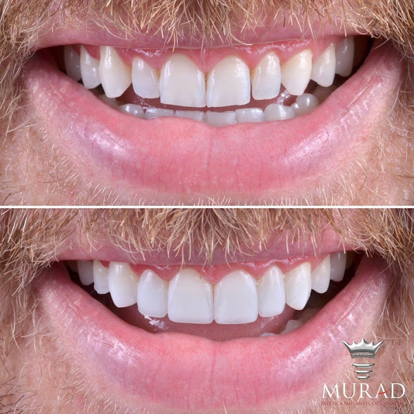 Foto 5 de Dentista Divinópolis | Lentes de Contato | Invisalign | Implante Dentátio | Clínica Murad