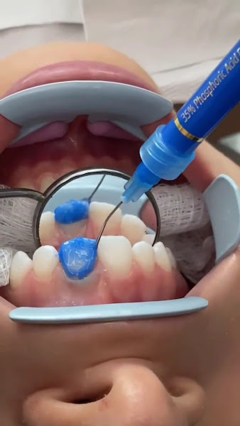Foto 3 de Dentista | Dr. Brunno Nepomuceno | Lentes Cerâmicas e Facetas em Resina Premium