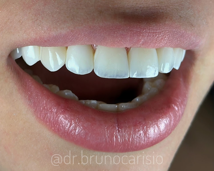 Foto 2 de Dentista - Dr. Bruno Carisio - Lentes de Resina e Implantes